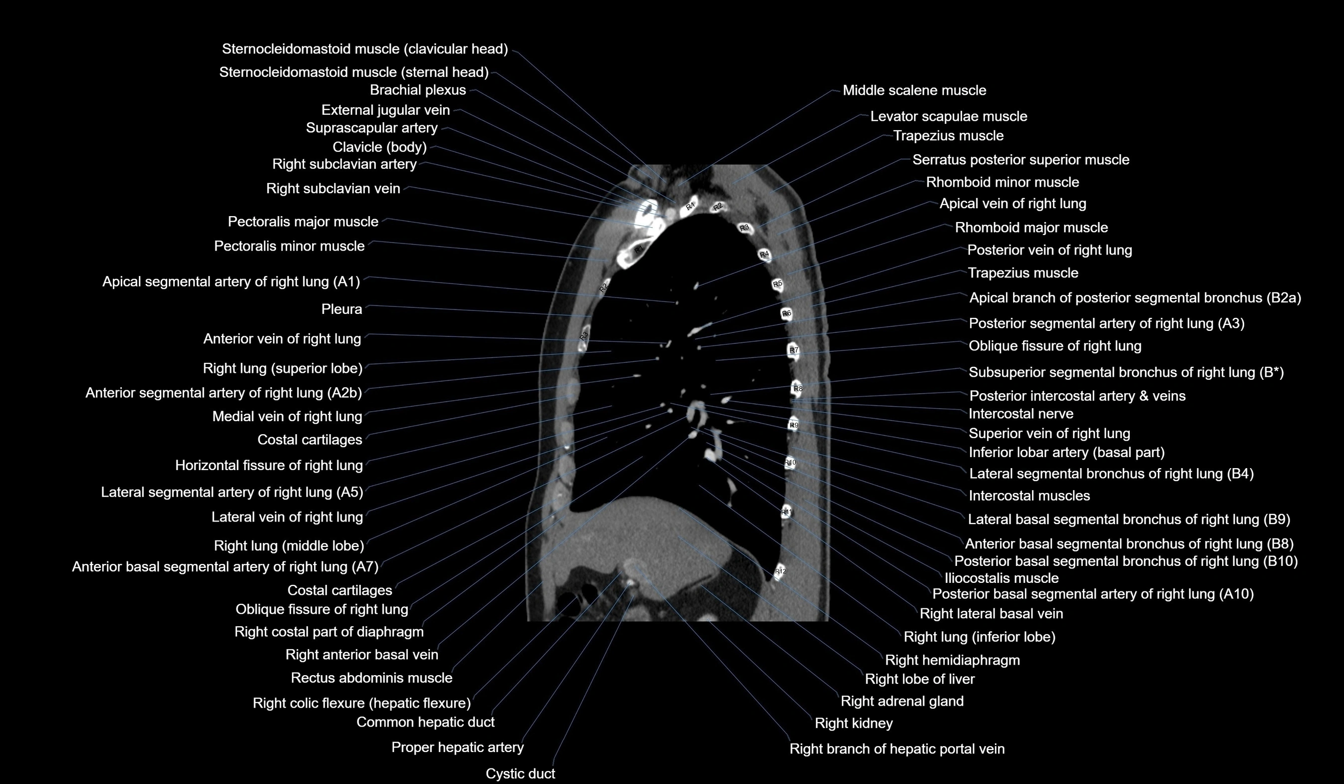 CT chest (thorax) labelled sagittal cross sectional anatomy radiology image-00051.webp